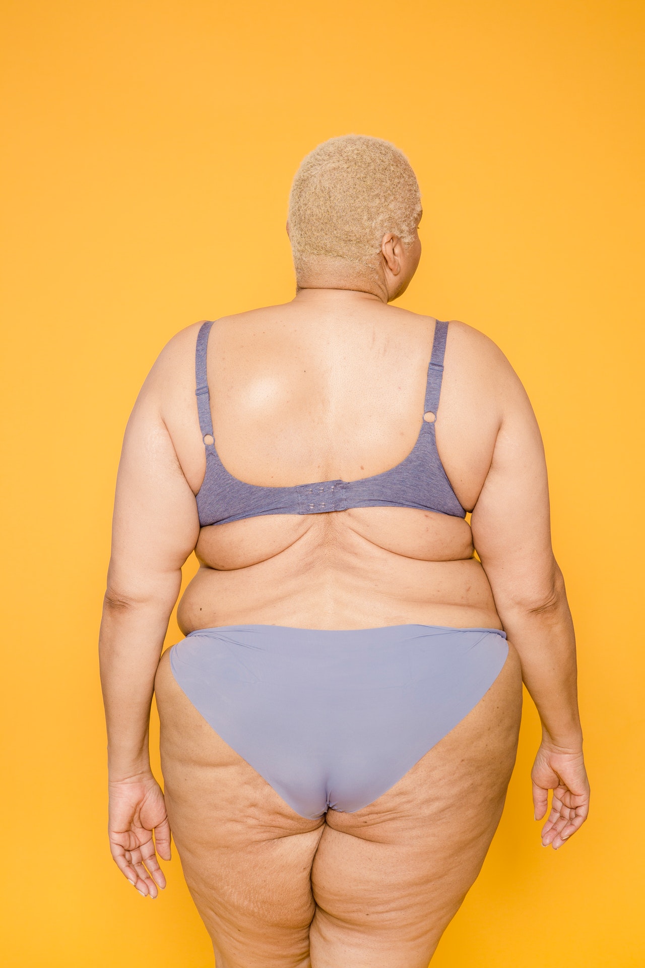 Lymphedema Obesity – Symptoms, Causes And Treatments