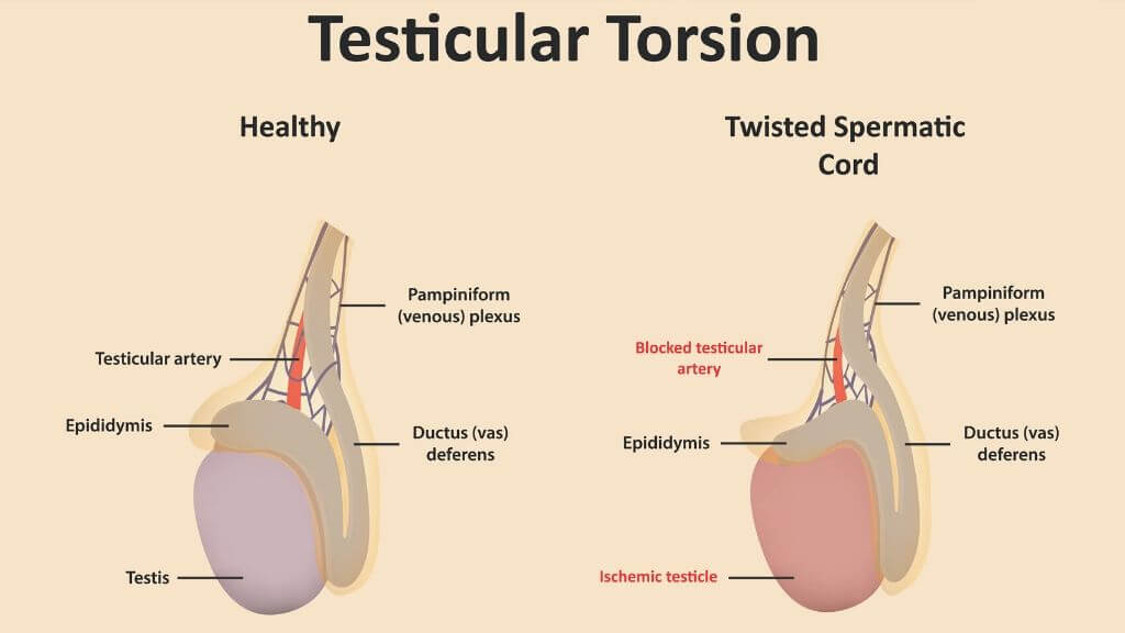 Torsion Of The Testis - Reaction After Hydrocelectomy