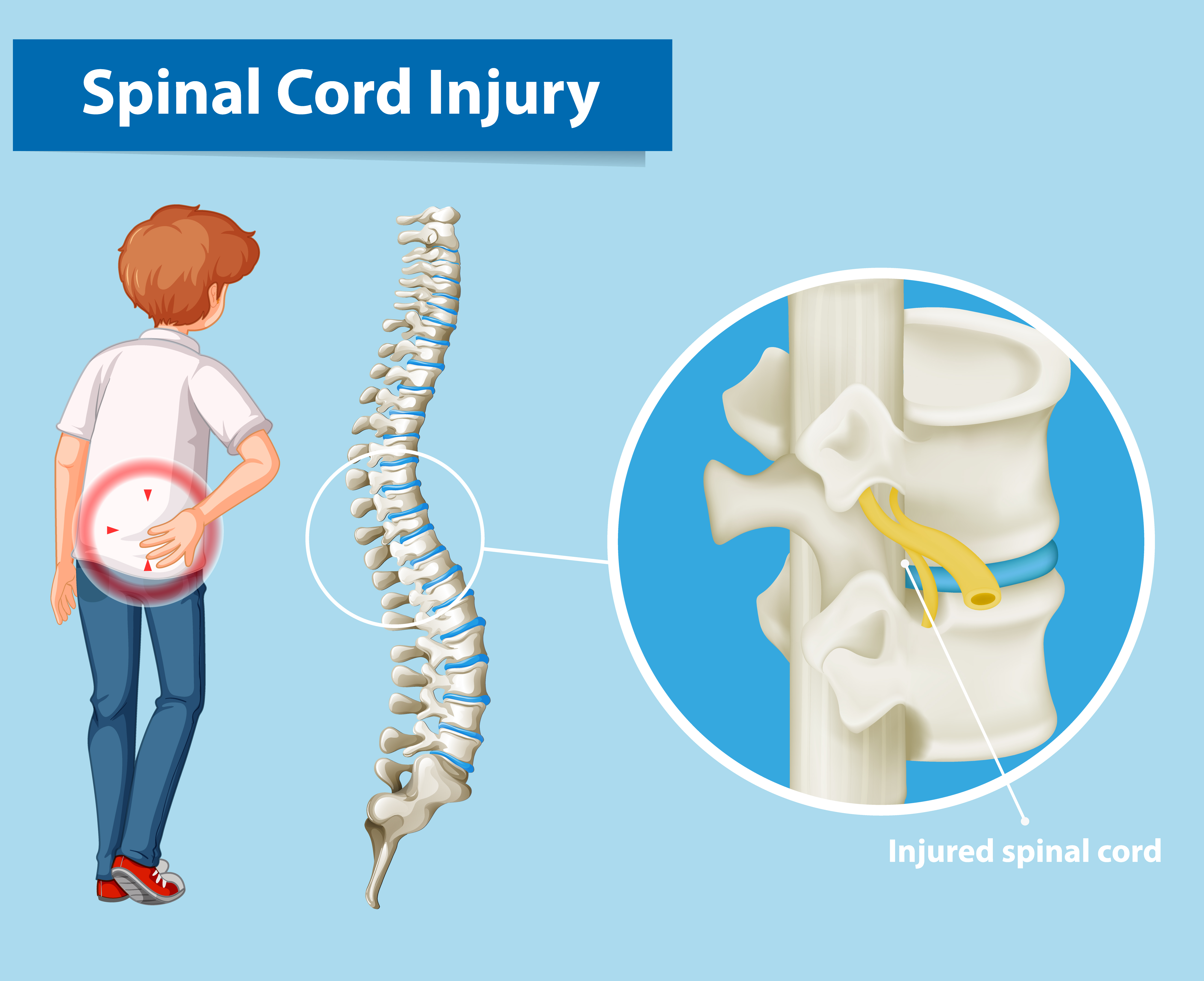 Traumatic Spinal Cord Injury – Injury Mechanism, Diagnosis And Recovery