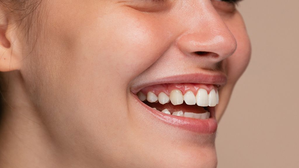 Dental Bonding - How It Has Aided In Teeth Restoration