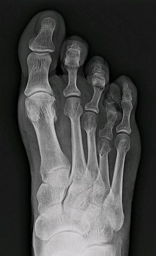 Foot bones X-ray