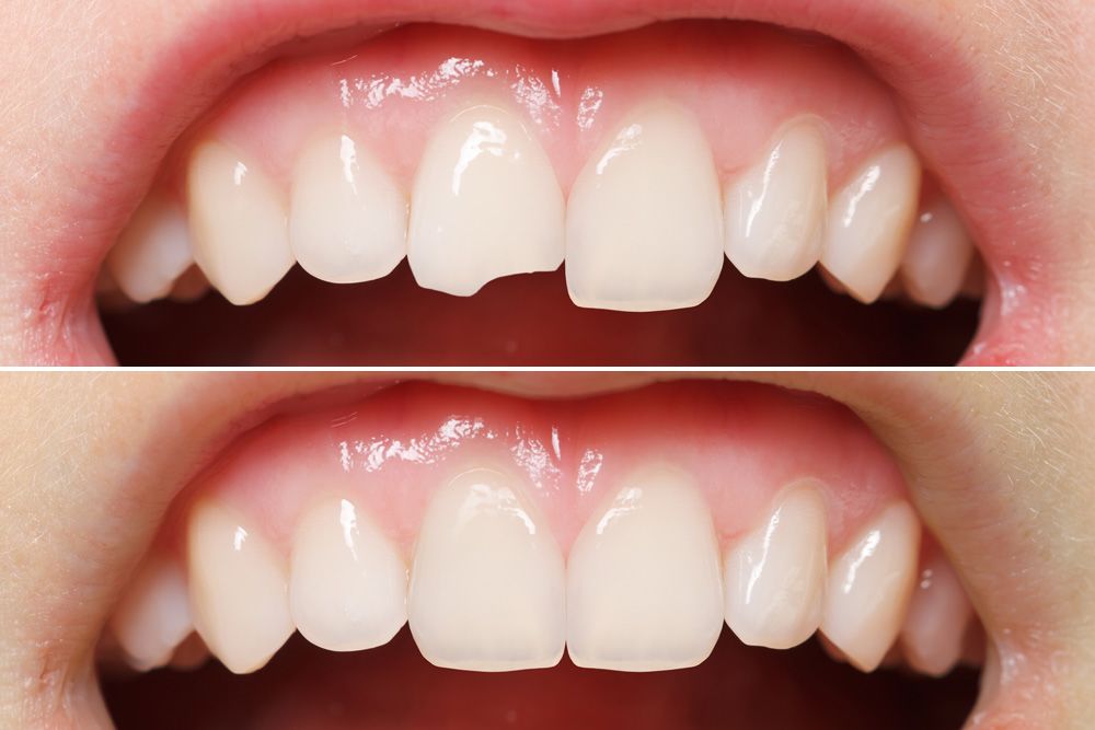 A human teeth before and after dental bonding