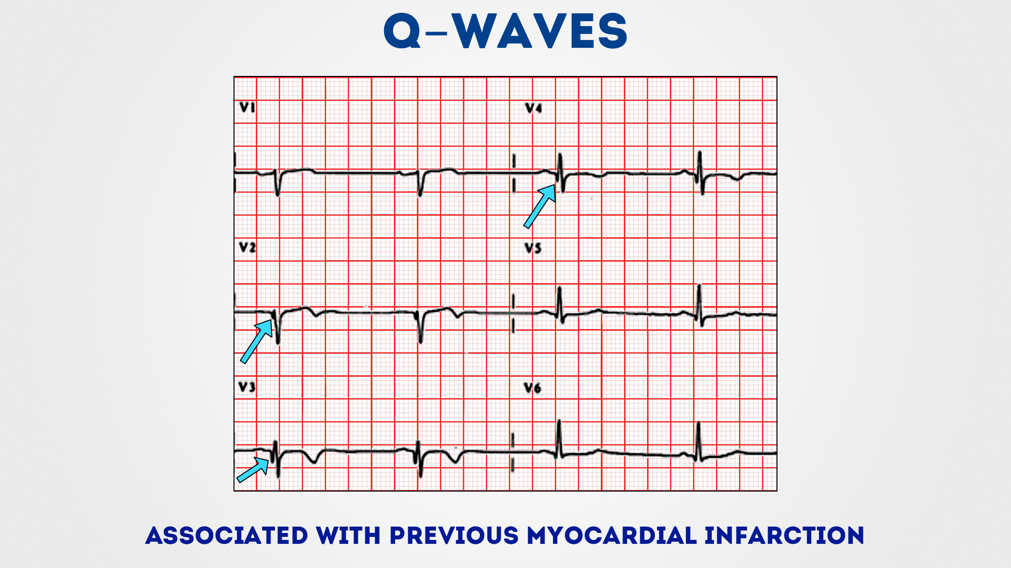 Q Waves On ECG – A New Diagnostic Tool In Cardiology