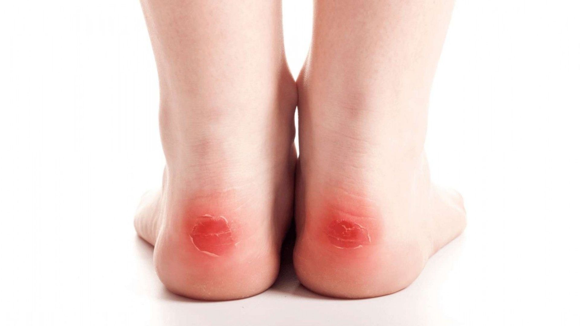 Reddish Skin Colour Of Back Side Of Feet