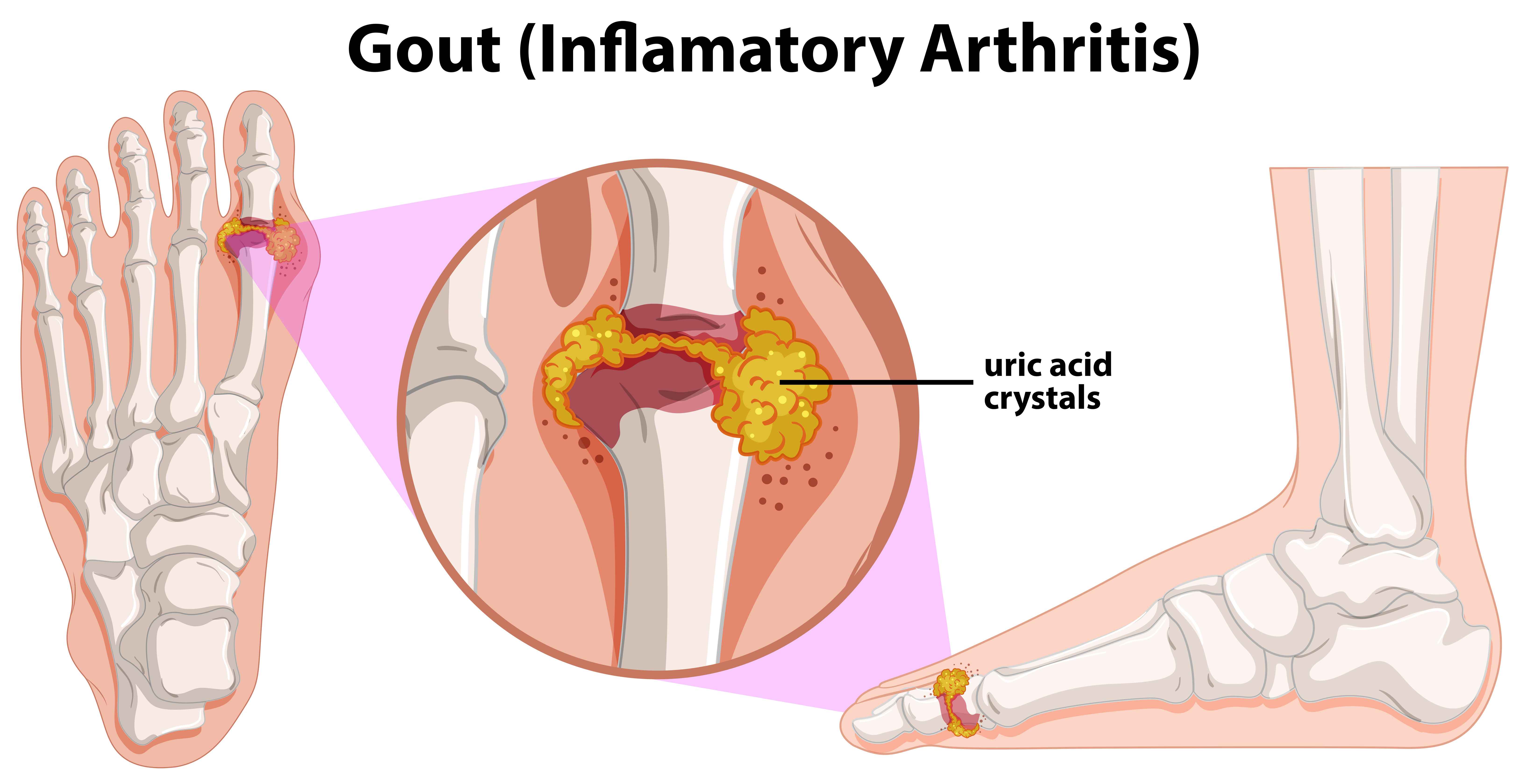 Gout In Spanish - Symptoms Of Gout And Why Should Spanish Speakers Care About It?