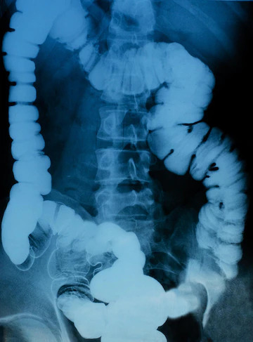 X ray of intestine in black and white color