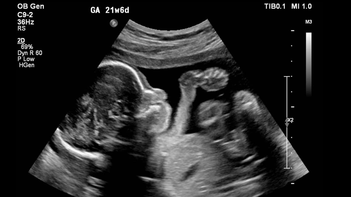 An ultrasound x-ray showing the baby in the fetus