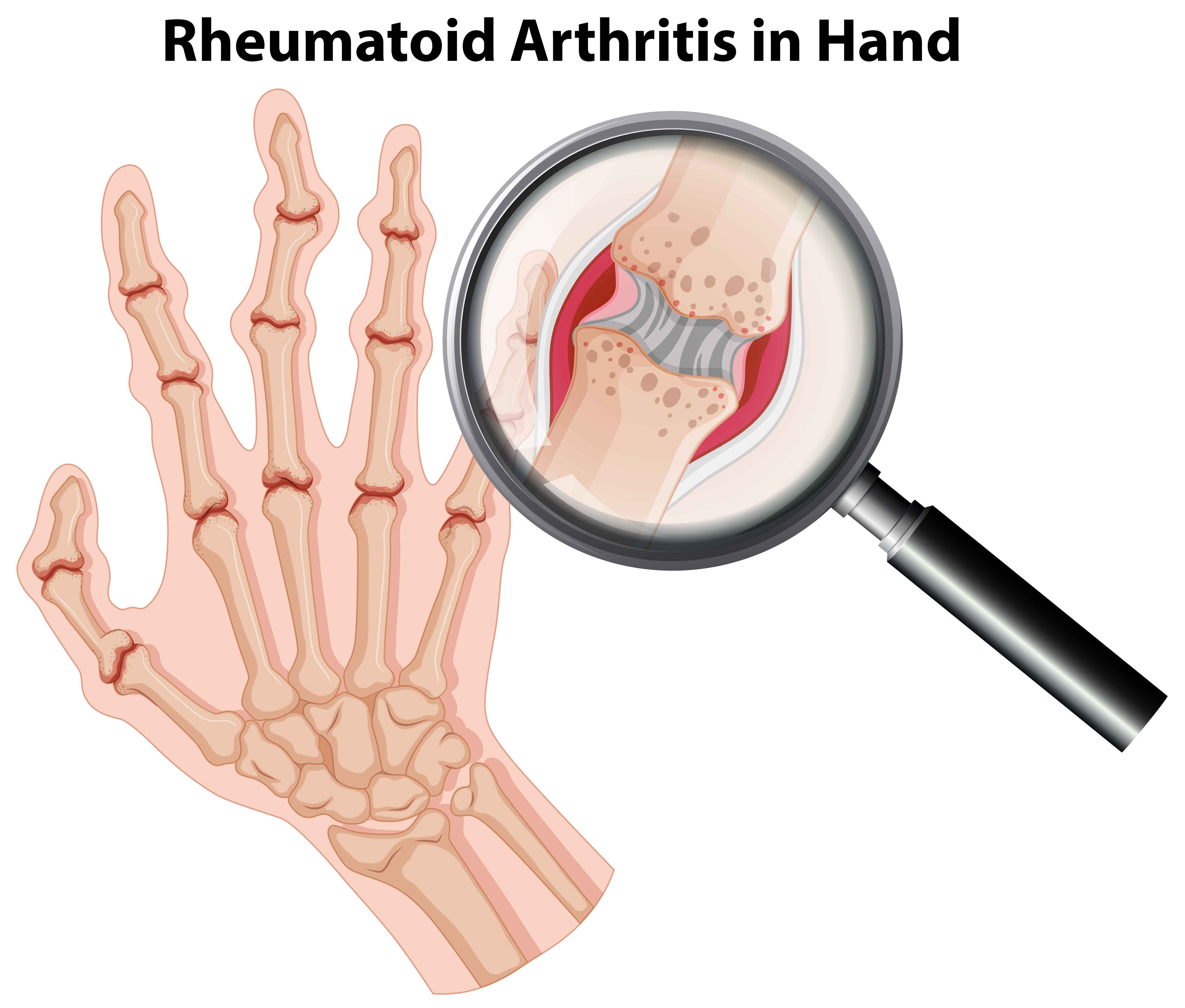 Visual description of human hand anatomy while rheumatoid arthritis is magnified