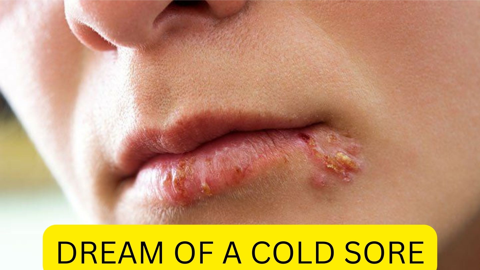 Dream Of A Cold Sore - Means Your Determination And Drive Toward Your Goals
