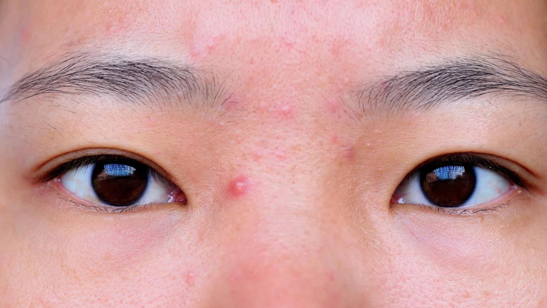 Pimples On Man's Face