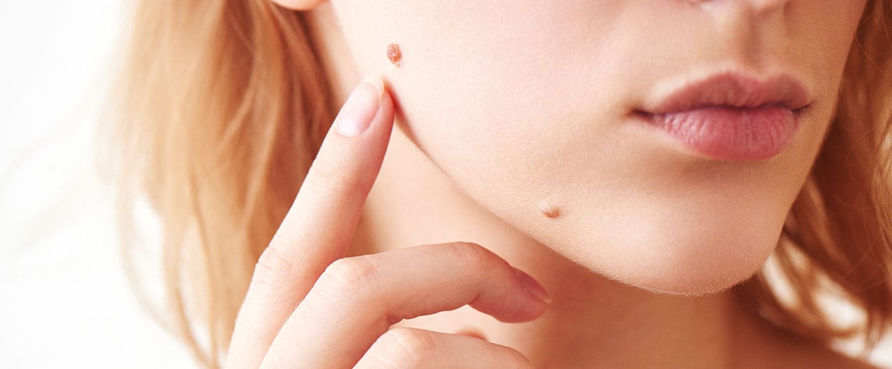 Skin Tag On Nipple - Should You Be Worried?