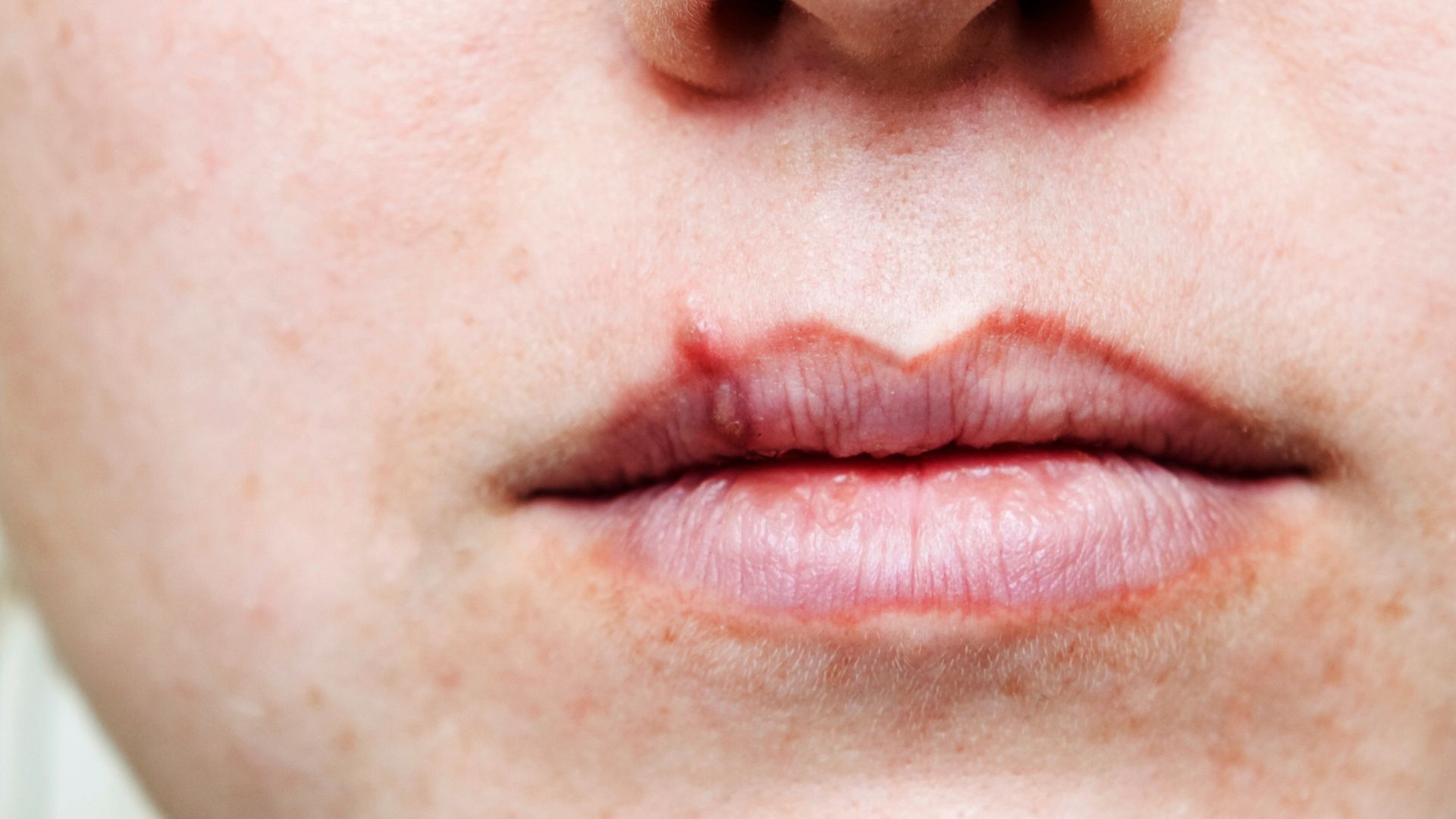 Cold Sore On Women Lips