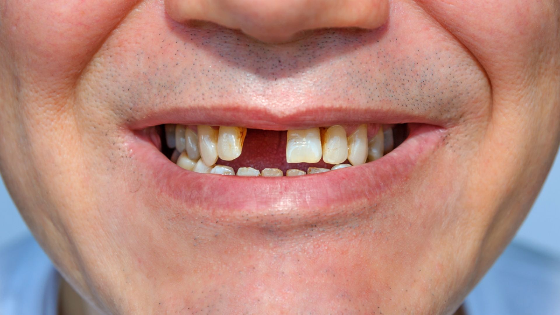 Man With A Broken Teeth Smiling