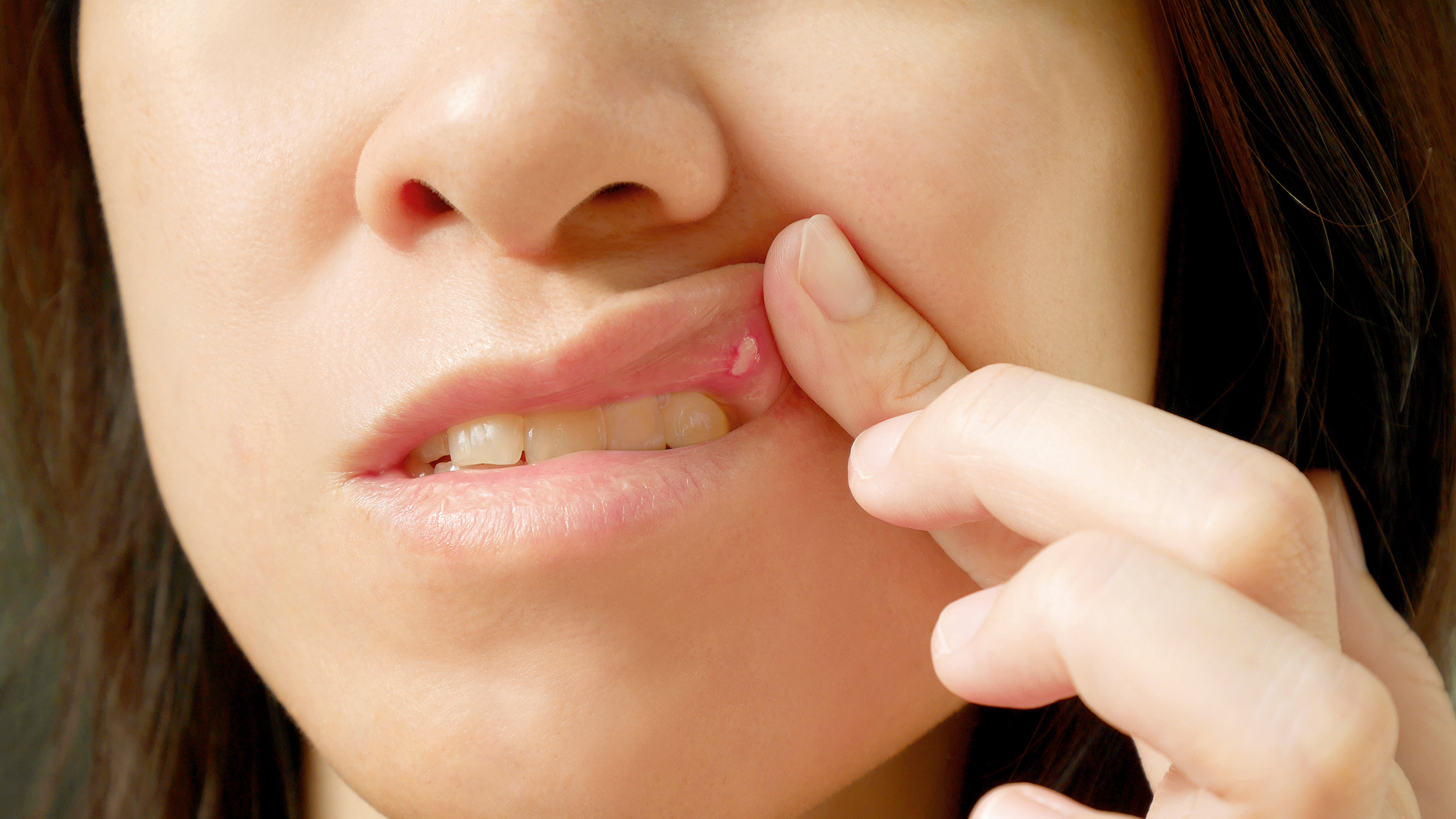 Treatment For Mouth Ulcers - Simple Home Remedies