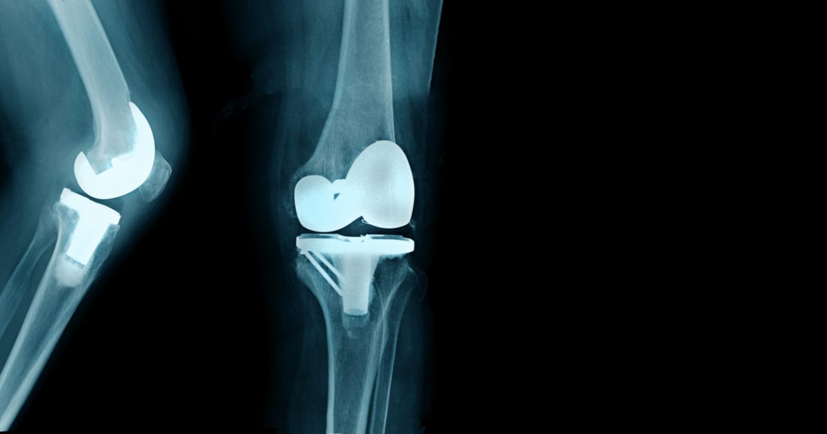 An x-ray of a knee that has undergone a total joint replacement
