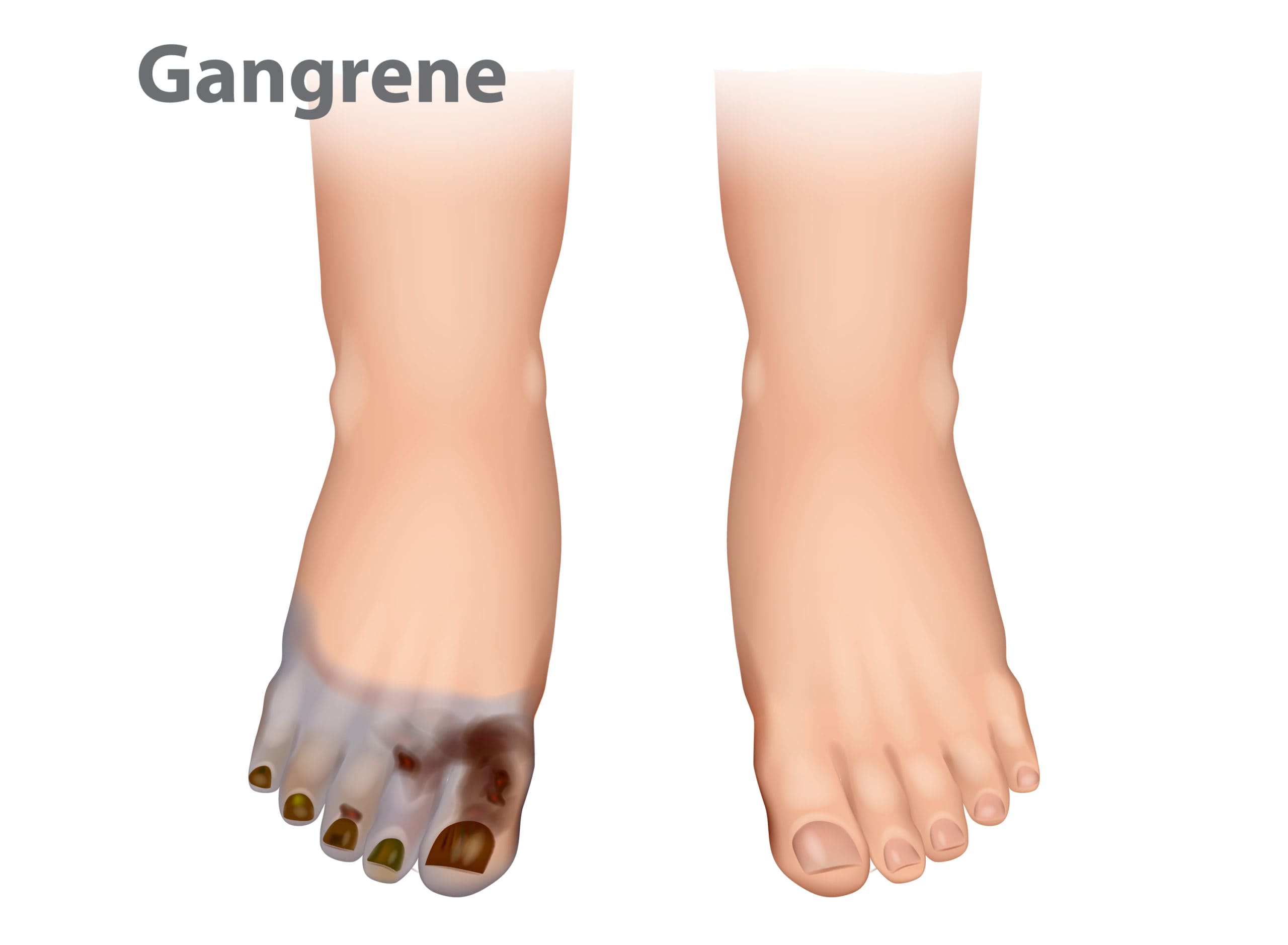 Cure For Gangrene - How To Improve Your Chances For Recovery