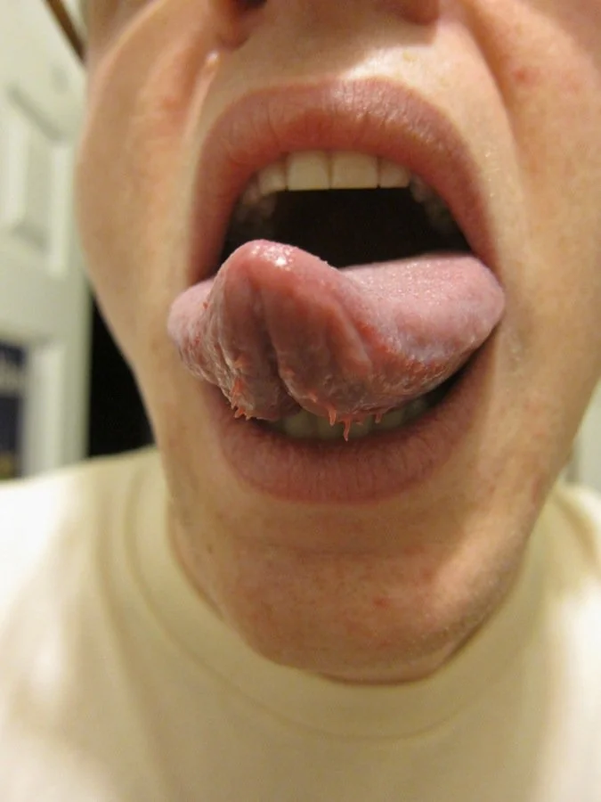 Do Skin Tags Under Tongue Go Away? How To Prevent Them From Coming Back