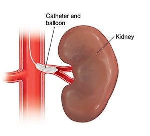 Visual description of closeup of kidney showing balloon catheter in renal artery