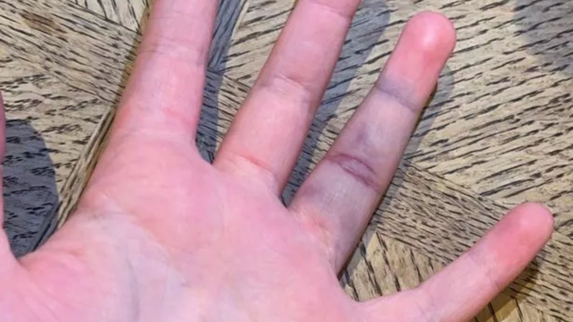 Finger Turning Purple