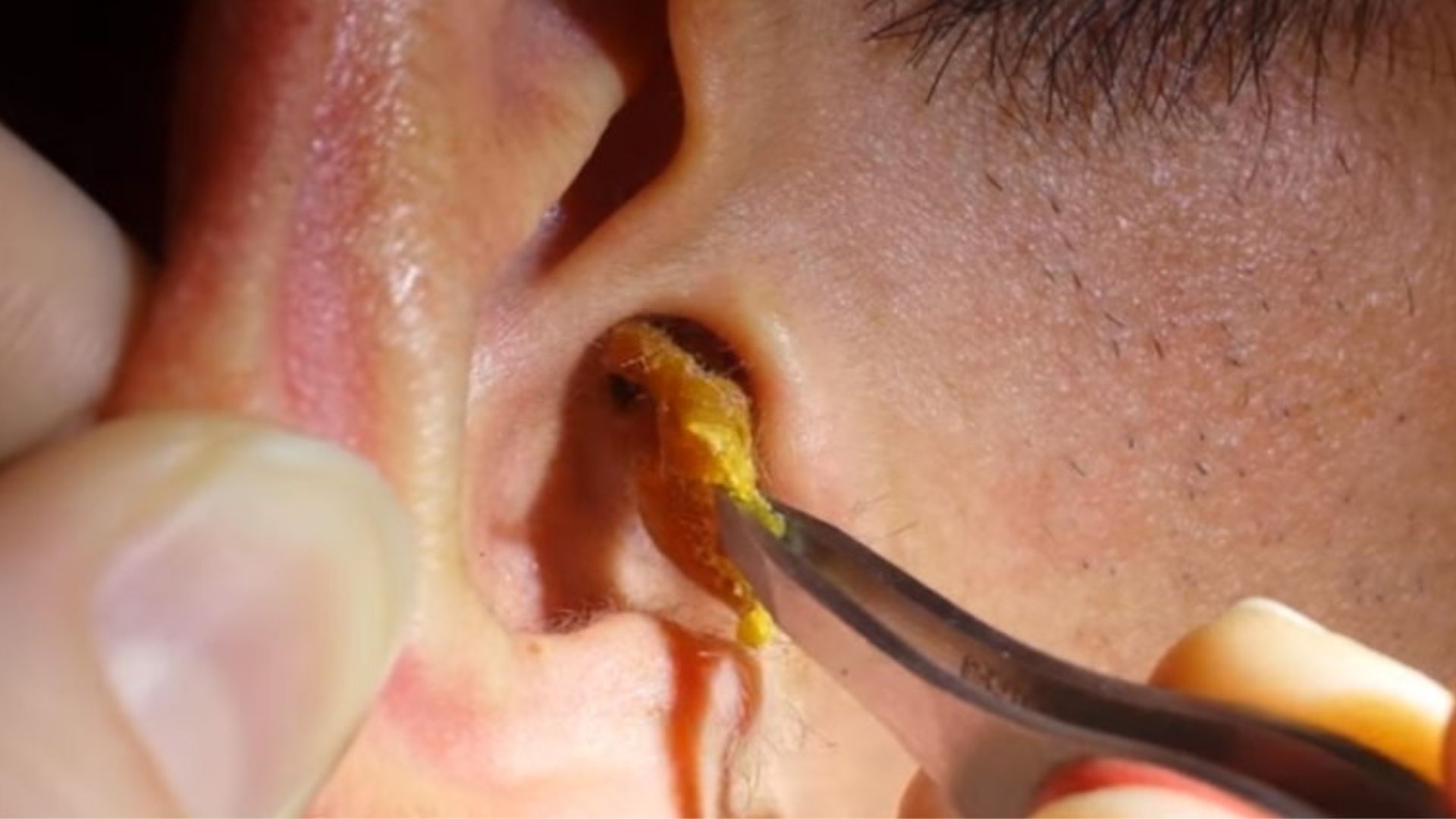 Dream About Earwax - Symbolize A Need To Cleanse One's Mind