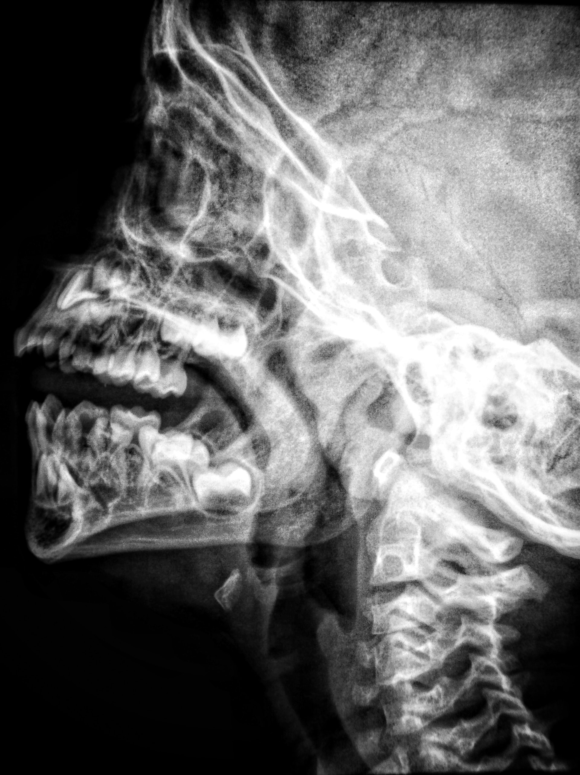 White and blak x-ray image