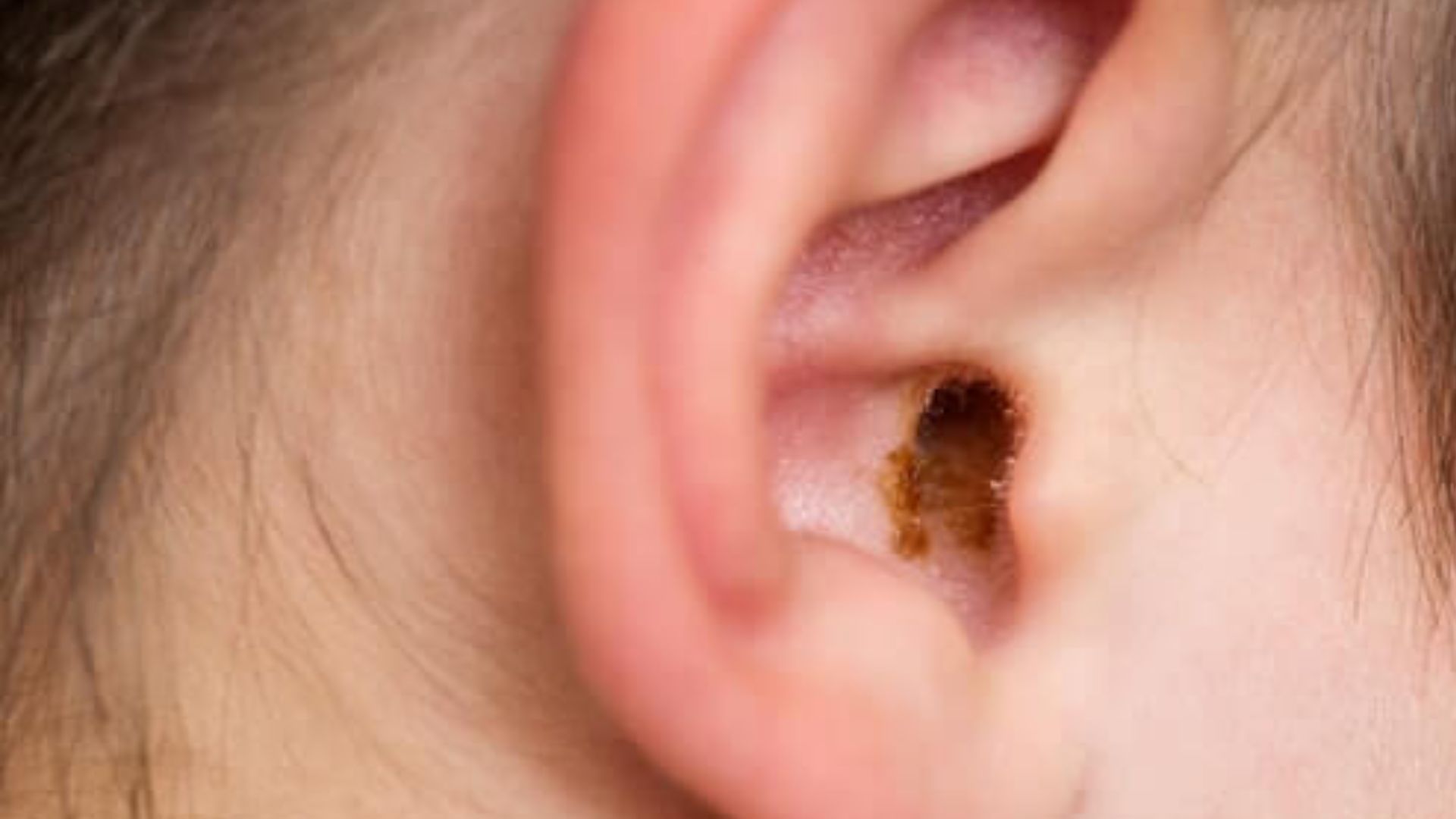 Ear Filled With Wax