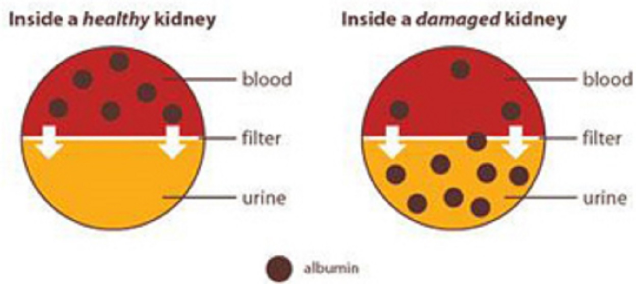 Two circles as healthy and damaged kidneys, with upper half in red for blood and lower half in yellow for urine