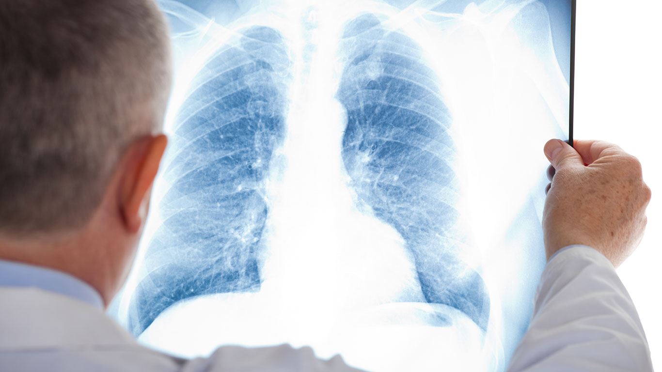 A doctor is looking lungs xray
