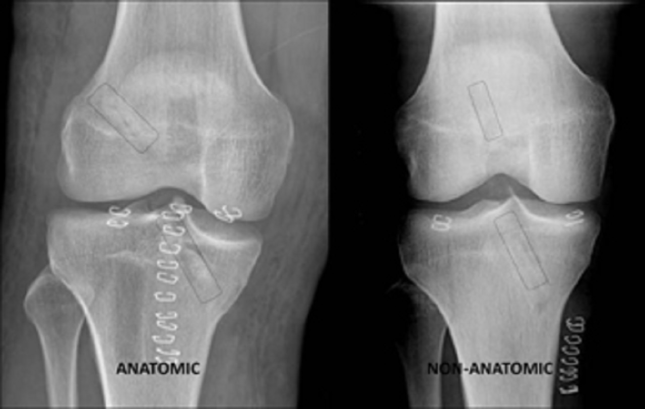 Two X-ray results of the anatomic and non-anatomic human knee joints