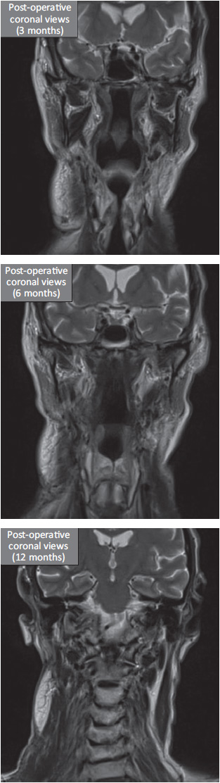 Post-operative MRI coronal views post-surgery and brachytherapy.