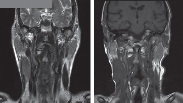 Pre-operative MRI coronal views of the radiation-induced high-grade spindle cell sarcoma of the sternomastoid muscle.