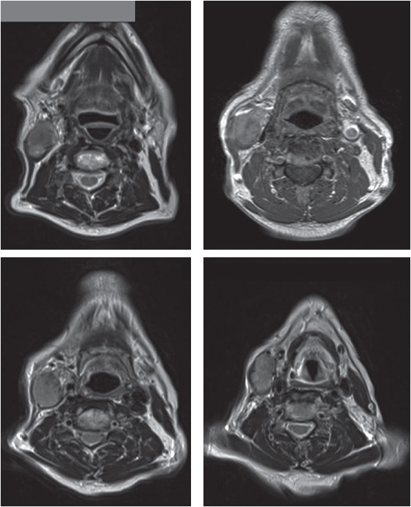 Pre-operative MRI axial views of the radiation-induced high-grade spindle cell sarcoma of the sternomastoid muscle.